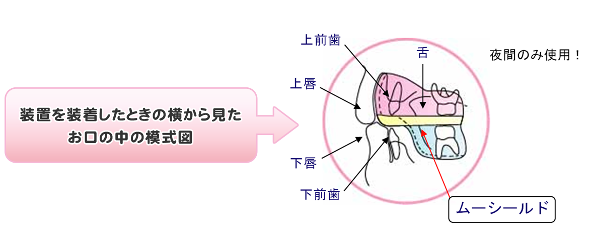 装置を装着したときの横から見た お口の中の模式図