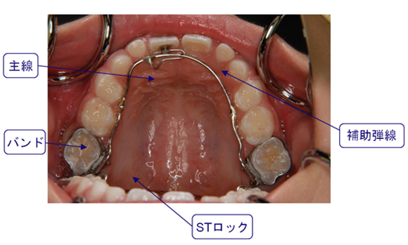 リンガルアーチ(Lingual arch)