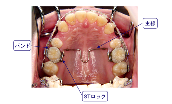 パラタルアーチ(Palatal arch)